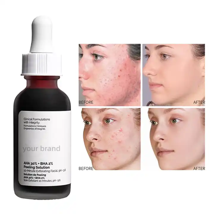 AHA BHA Peeling Solution for Anti-acne Exfoliating